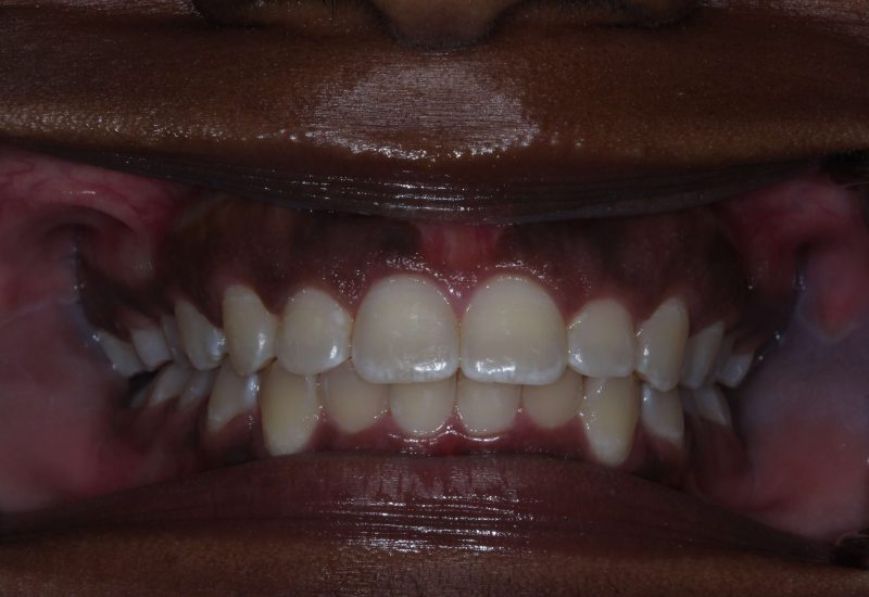 Gingivectomy after