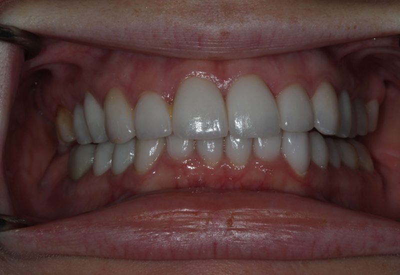 Full Mouth Rehab after
