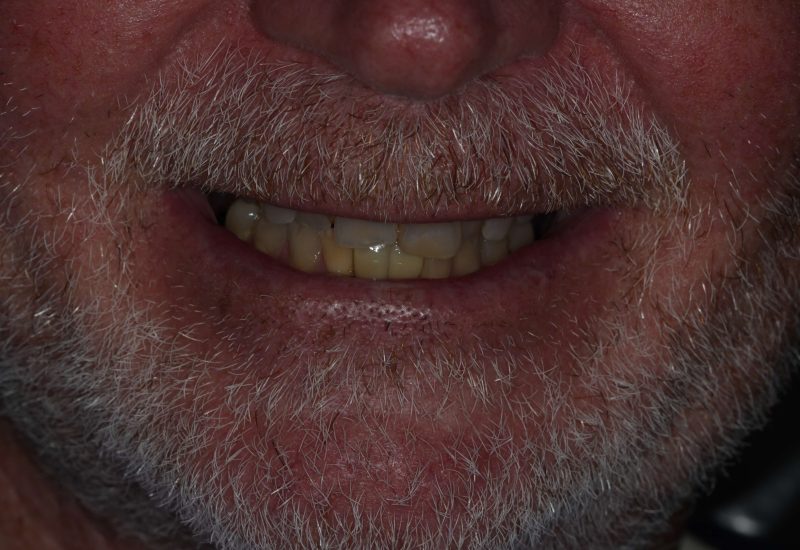 Anterior Composites before