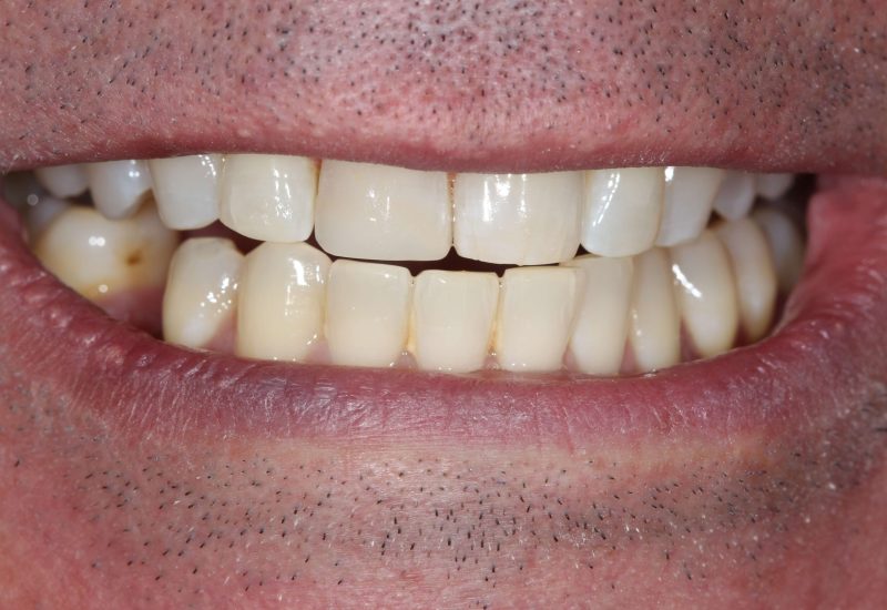 Composite Veneer after