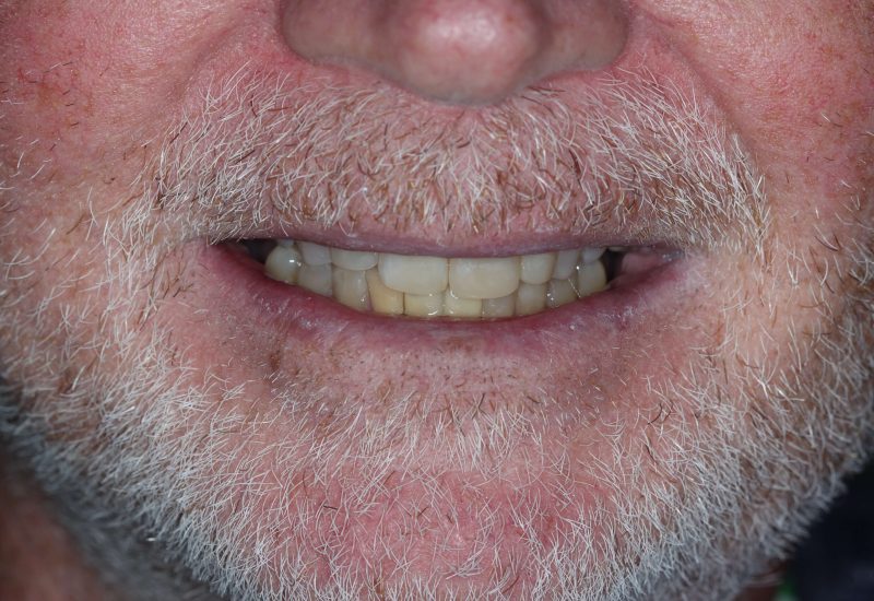 Anterior Composites after