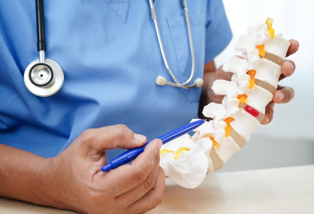 Asian doctor holding spinal nerve and bone model, Lumbar spine displaced herniated disc fragment