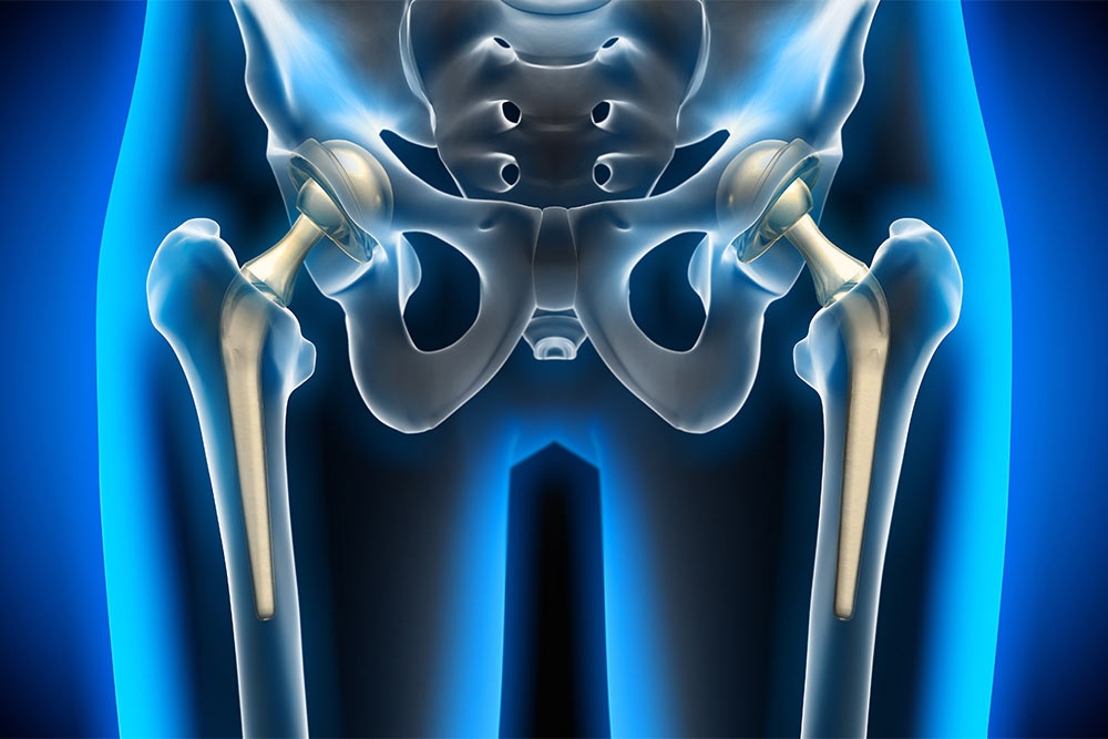 What You Should Know About Anterior Hip Replacement