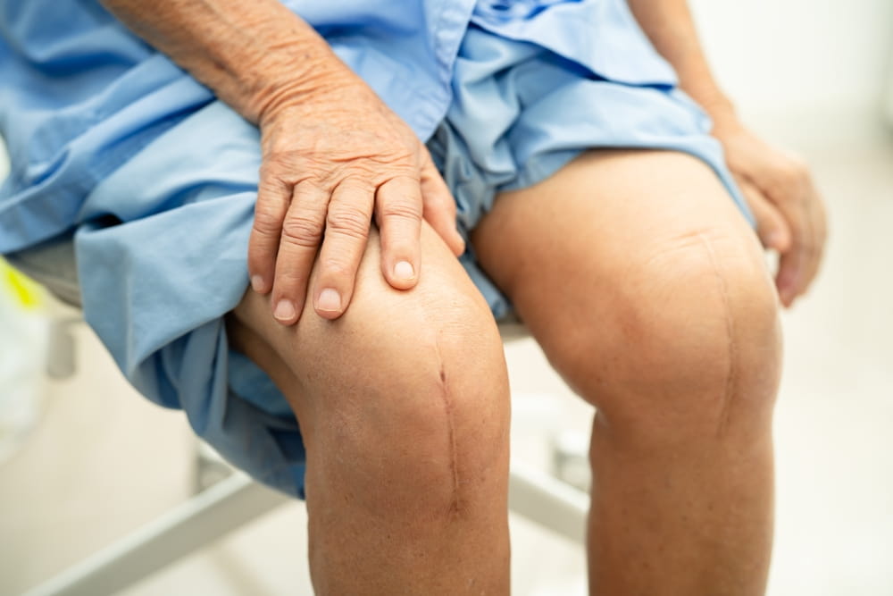 Asian elderly woman patient show her scars surgical total knee joint replacement Suture wound surgery arthroplasty on bed in hospital.