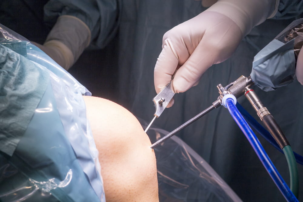 Surgical operation for knee arthroscopy micro surgery in hospital operating theater emergency room of traumatology and orthopedics.