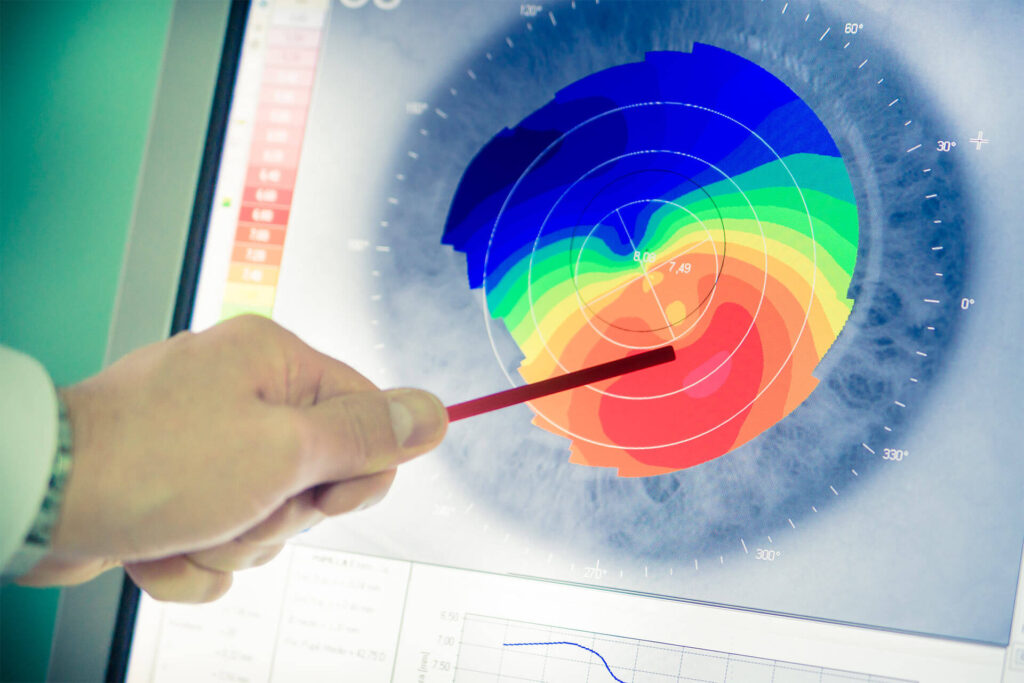 CRT Corneal topography
