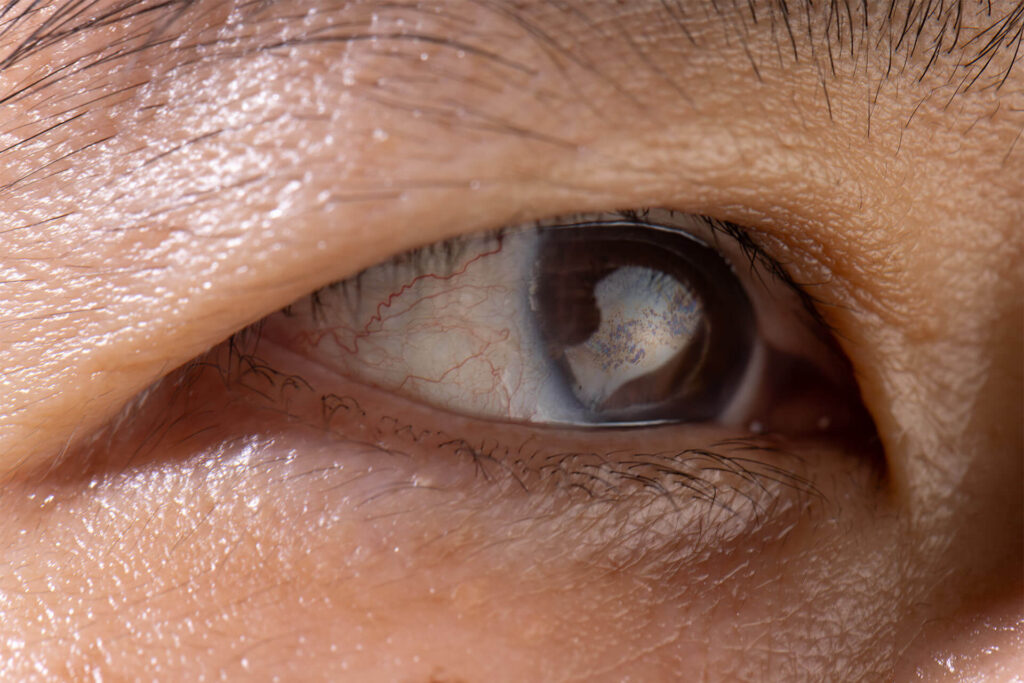 Cataracts