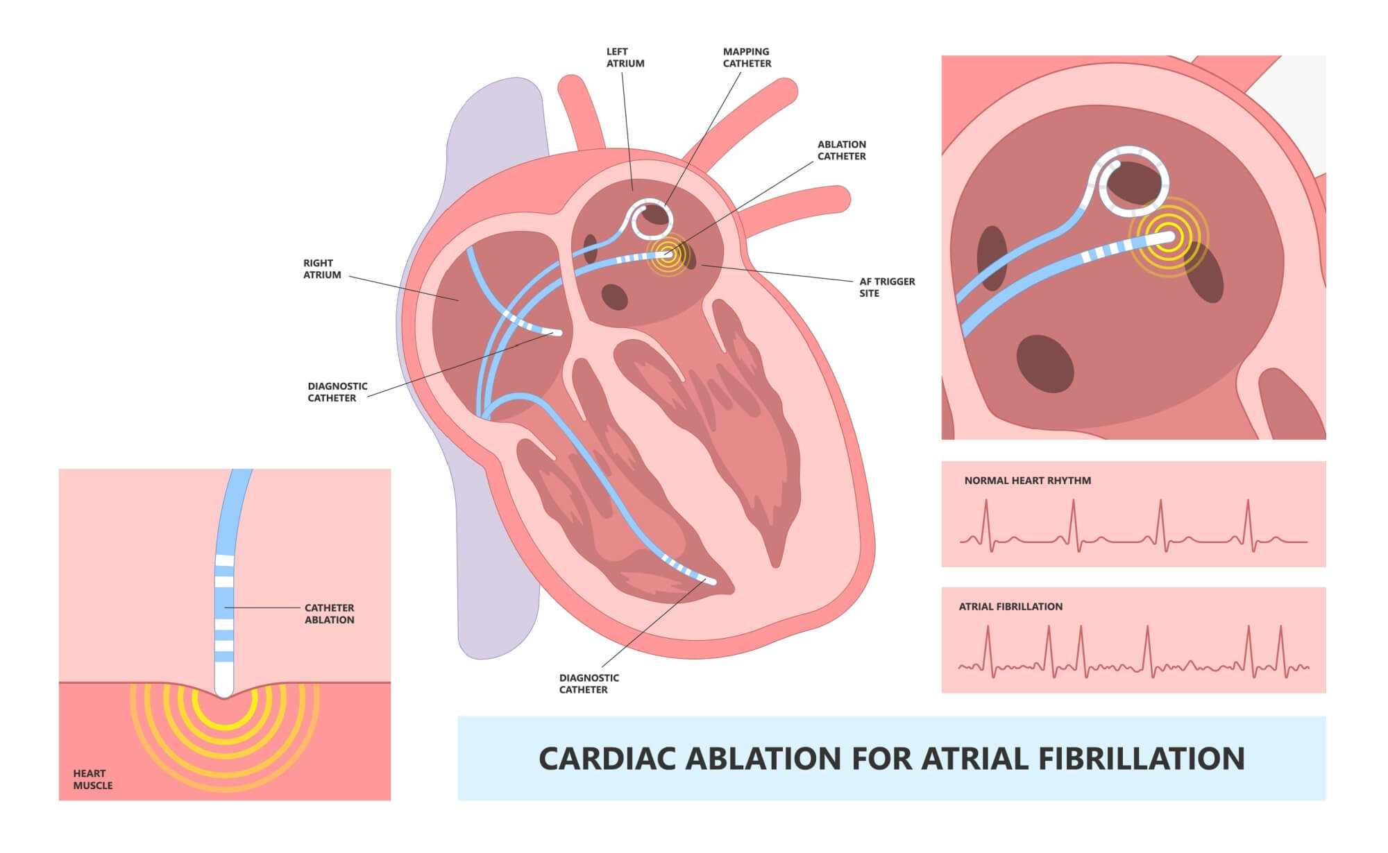 Atrial Fibrillation & Flutter Treatment