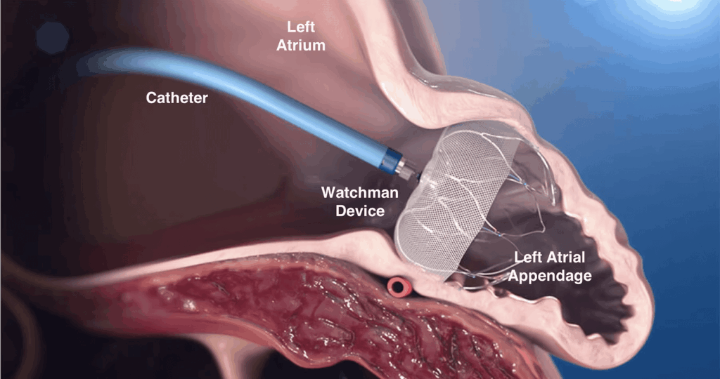 Watchman & Amulet Device Implants (LAAO)