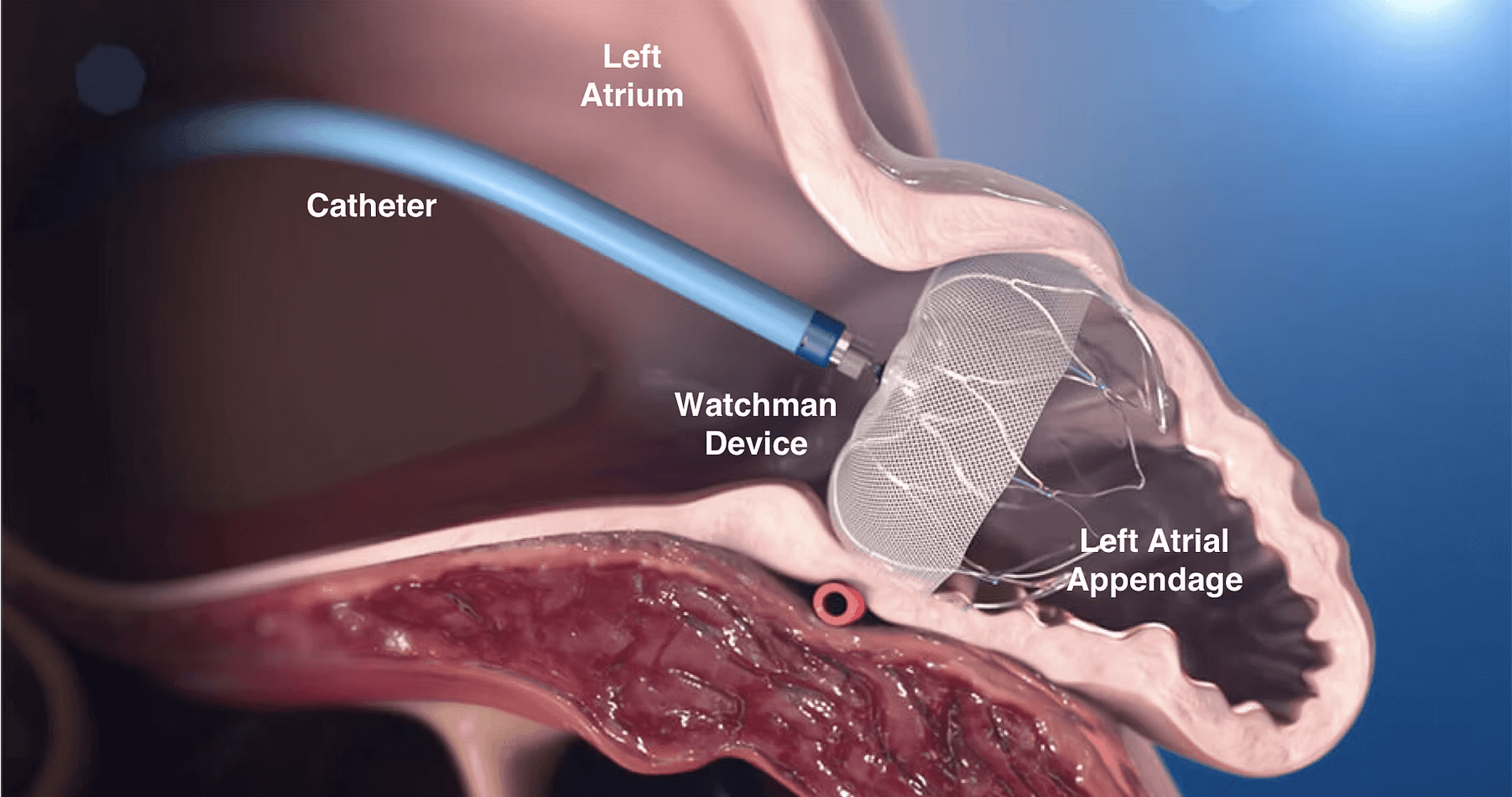 Watchman & Amulet Device Implants (LAAO)
