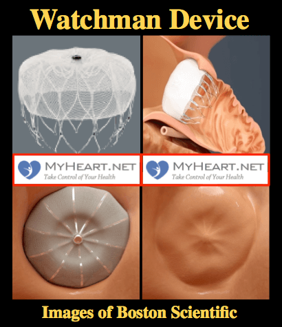 WATCHMAN Device Implant