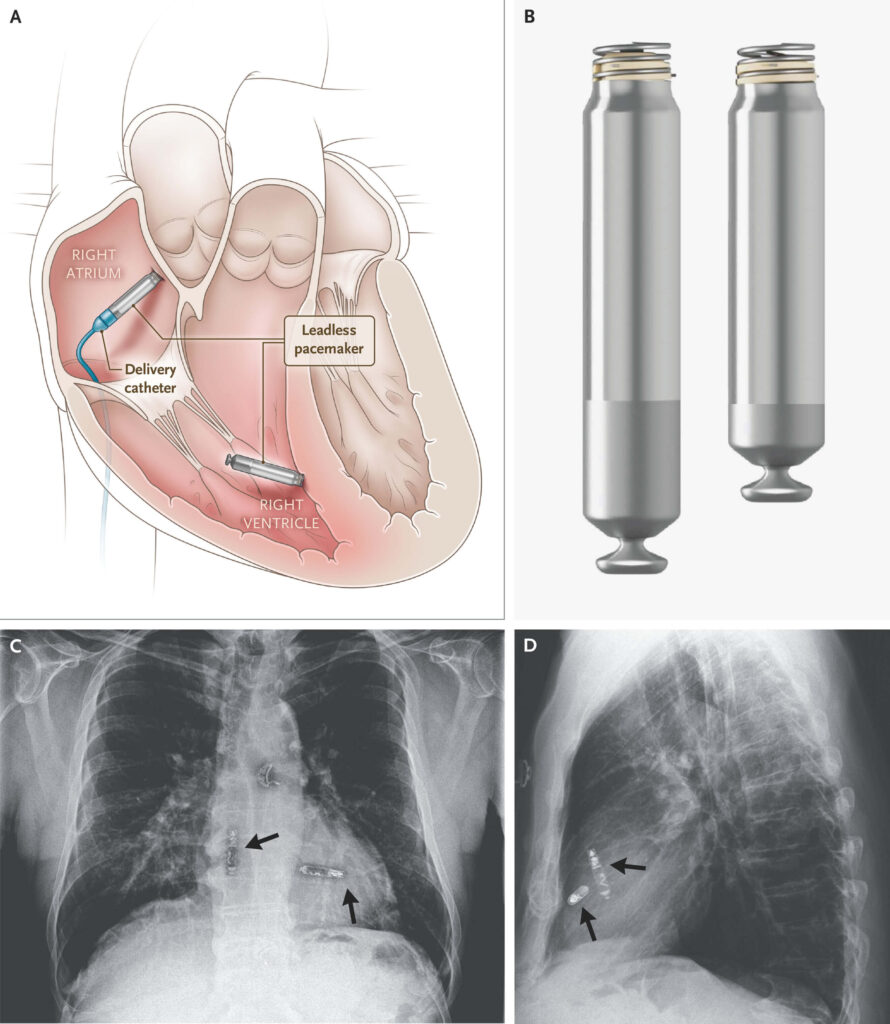 Leadless Pacemaker Implants
