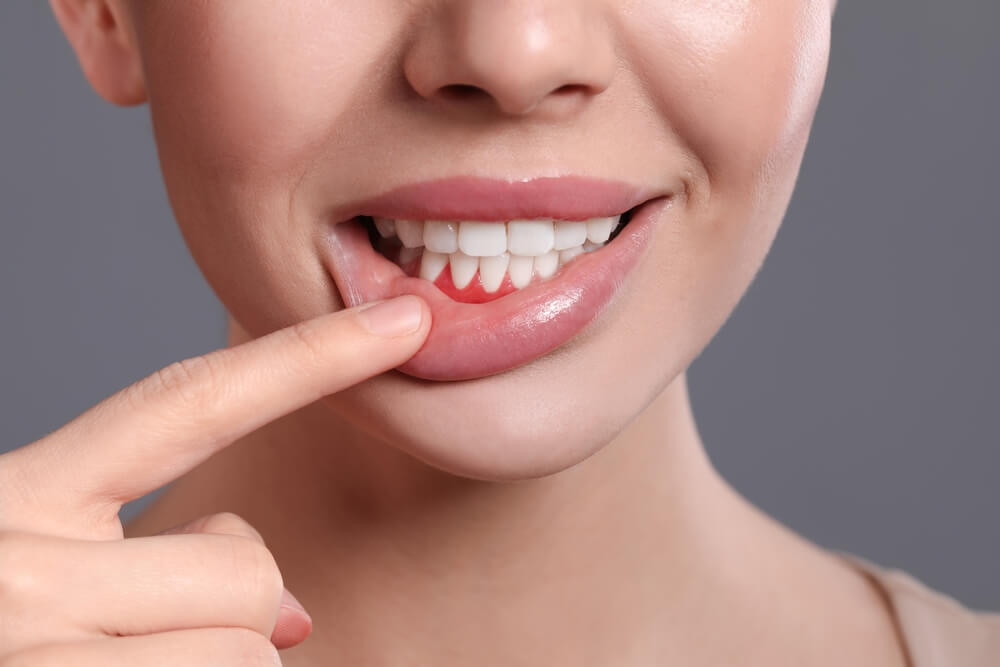 Young woman showing inflamed gums