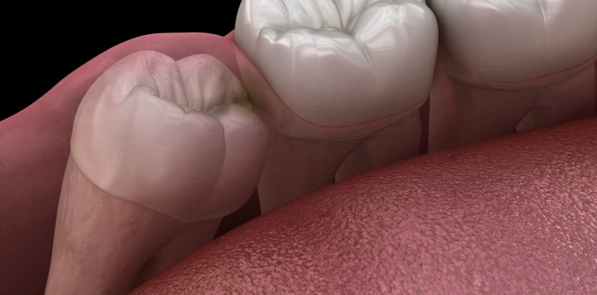 Impacted Teeth