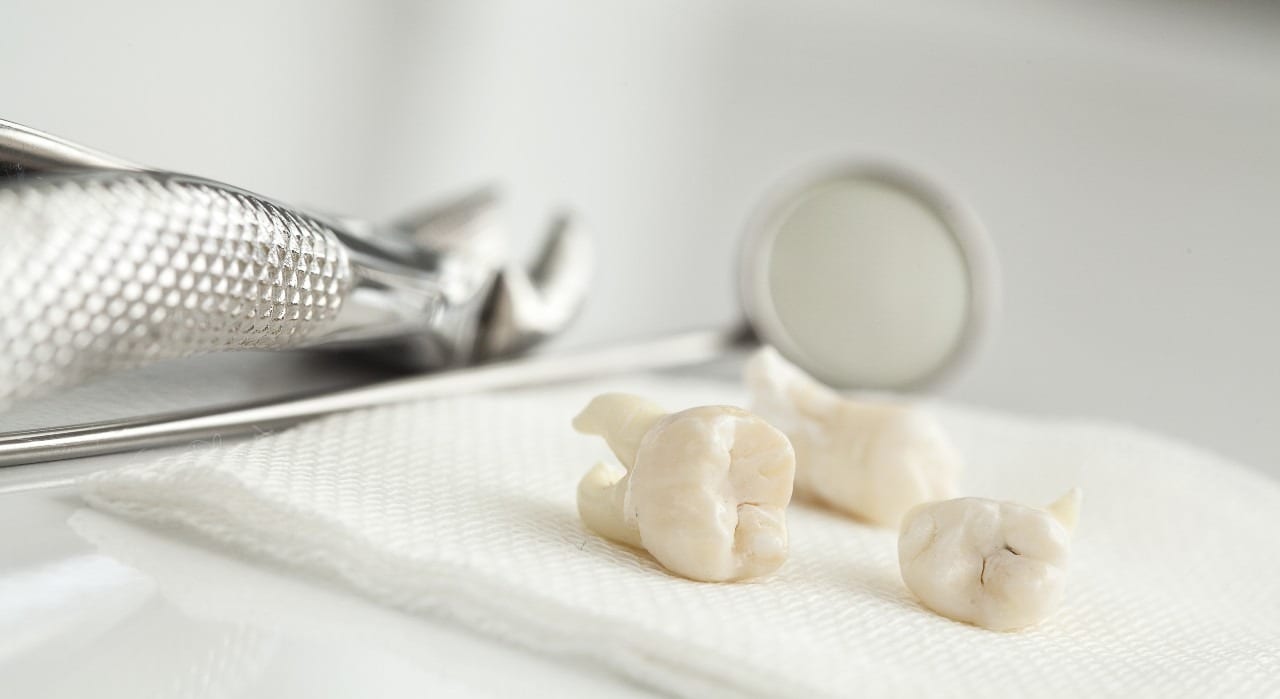 Tooth Extractions