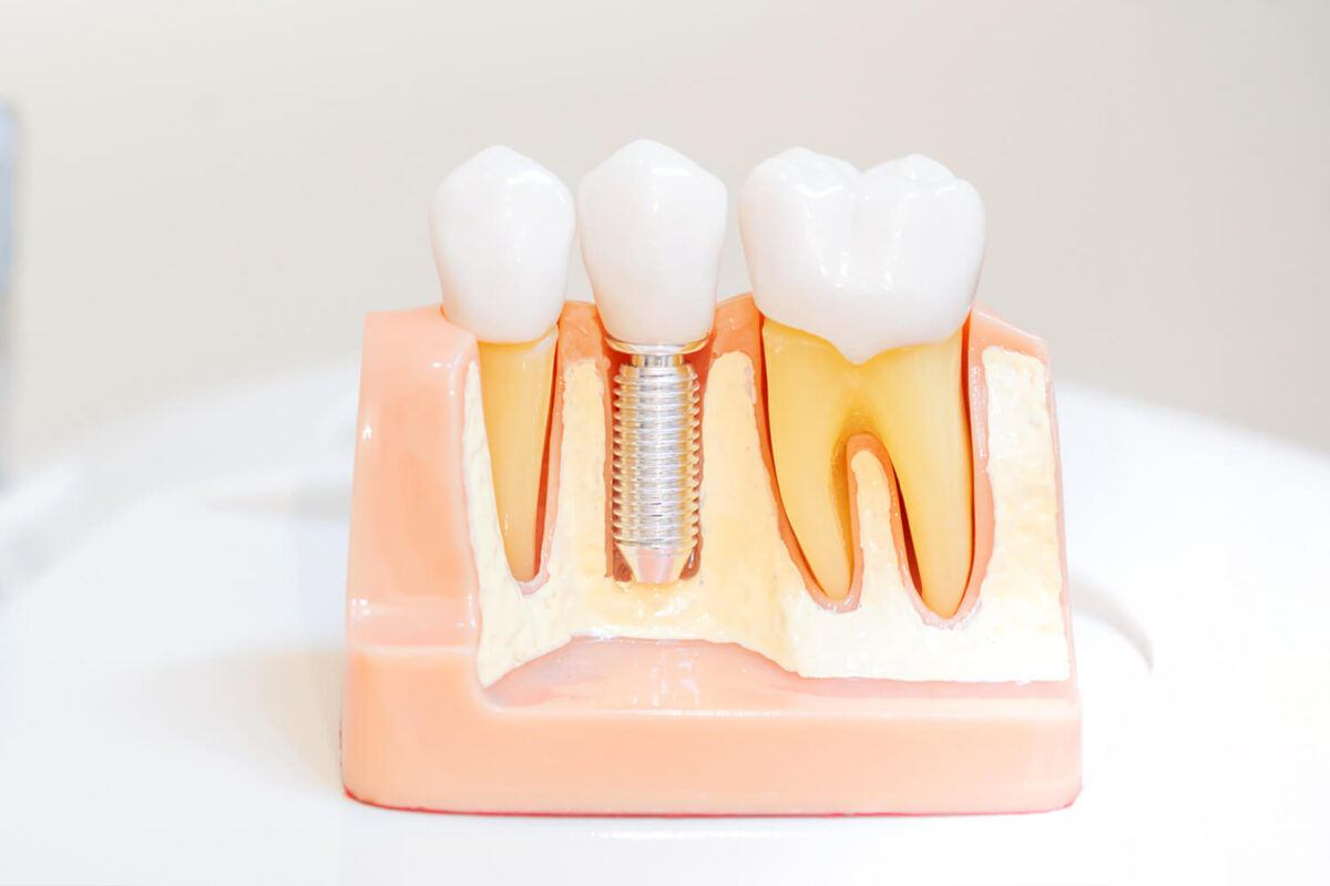 Dental Implants