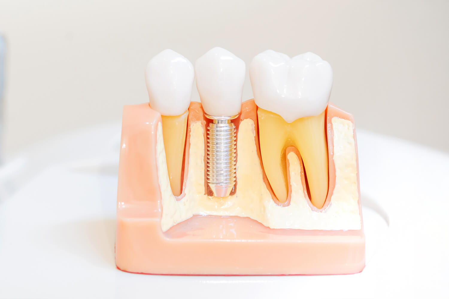 Dental Implants