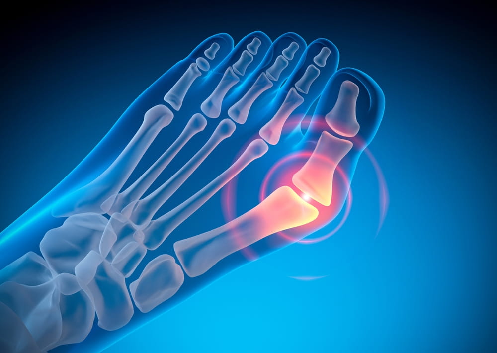 Hallux Valgus - Valgus deformity of the big toe - 3D illustration