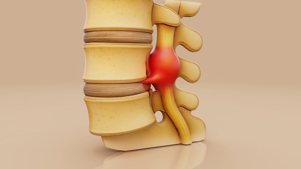 Conceptual 3D illustration of a herniated disk in the lumbar spine