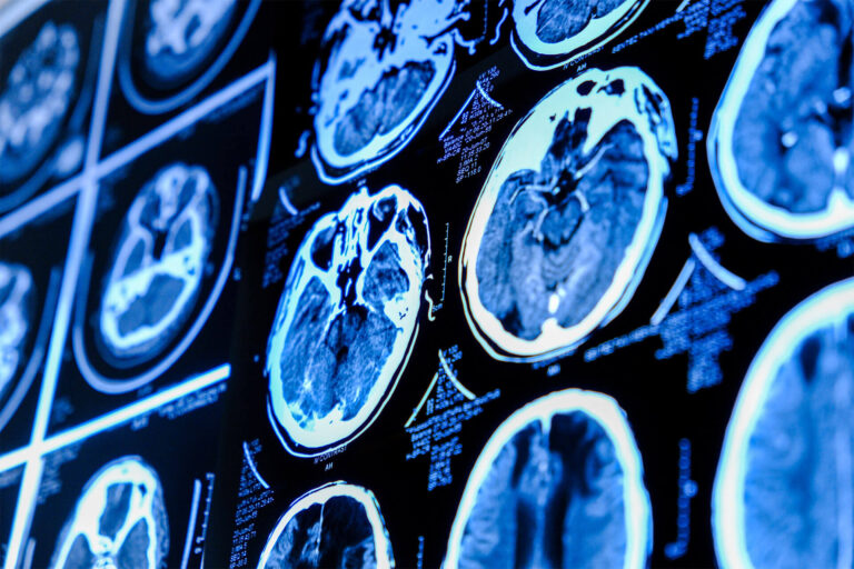 Close-up of CT scan with brain