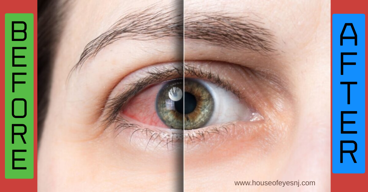 before-and-after-ipl-dry-eye