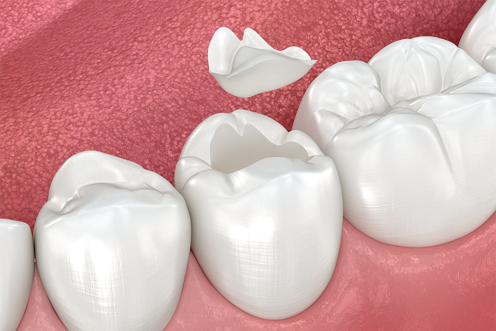 Ceramic Fillings
