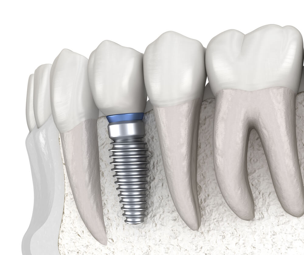 Dental Implants