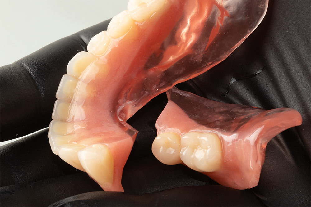 Hybrid Fixed Dentures