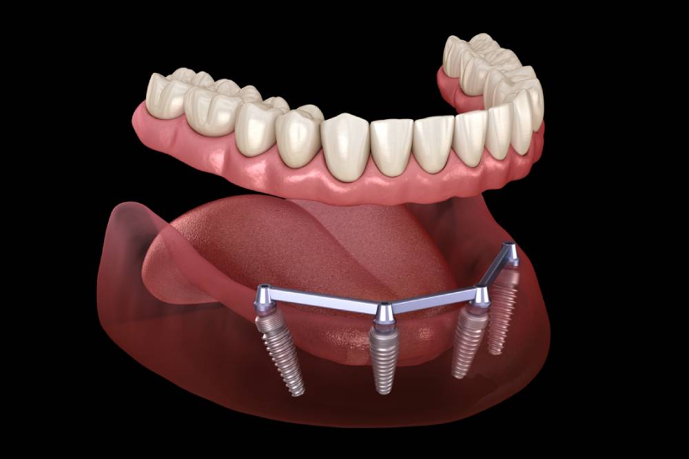 Implant Supported Dentures