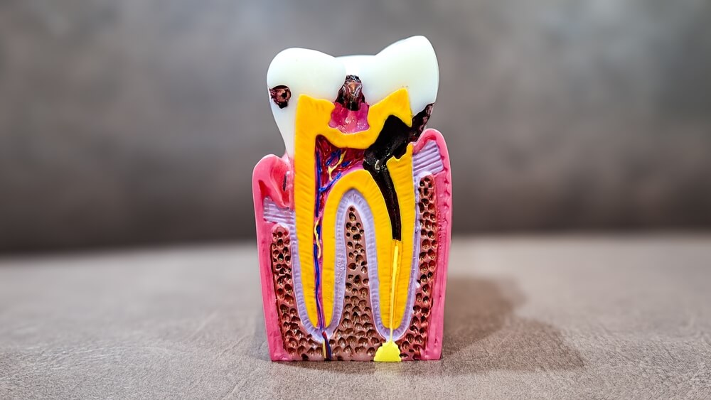illustration. Decay tooth replace with dental implant root canal teeth mode