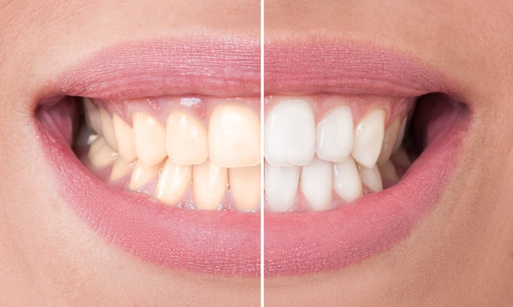 Start-Pure-teeth-whitening