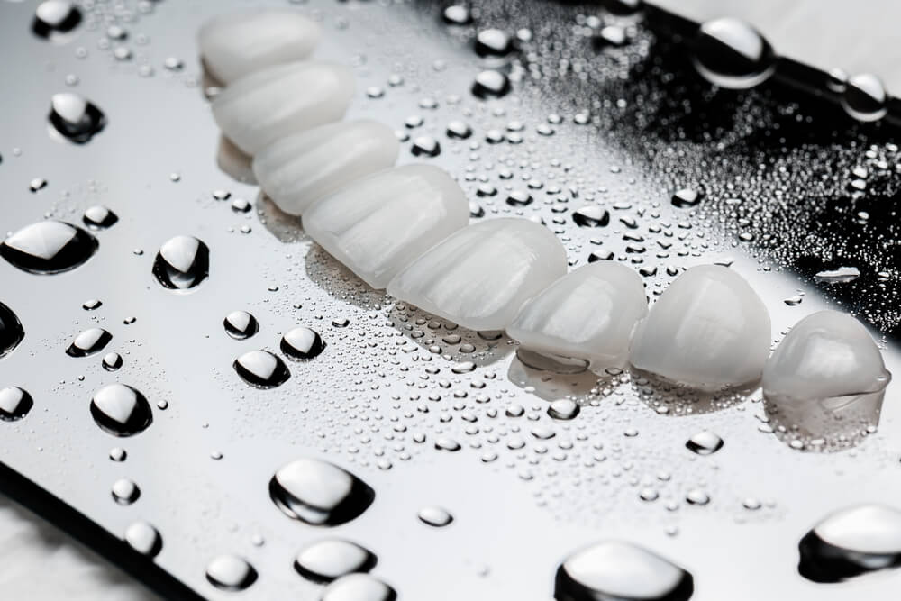 Veneers and Laminates