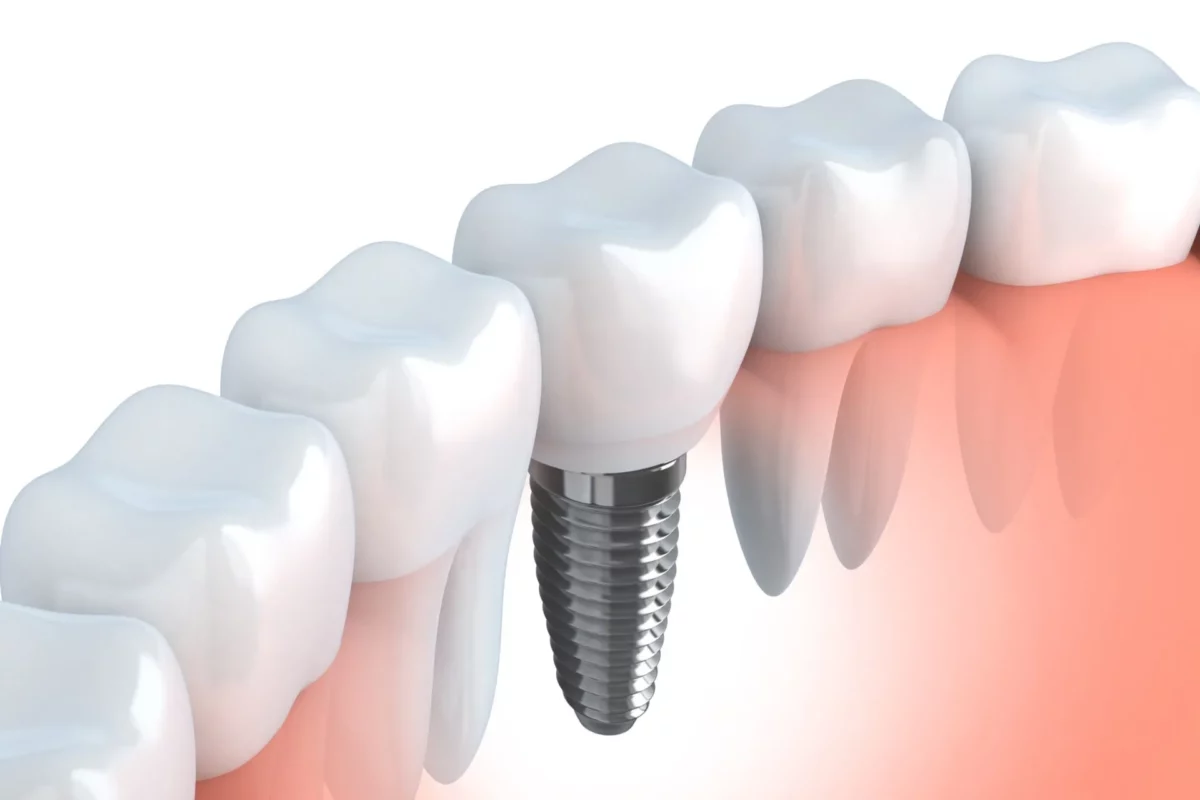 implants