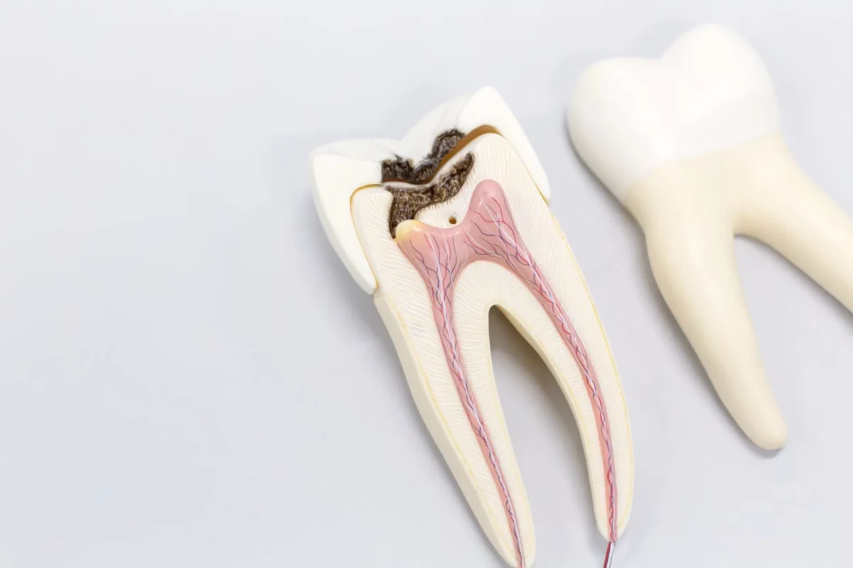 root-canals