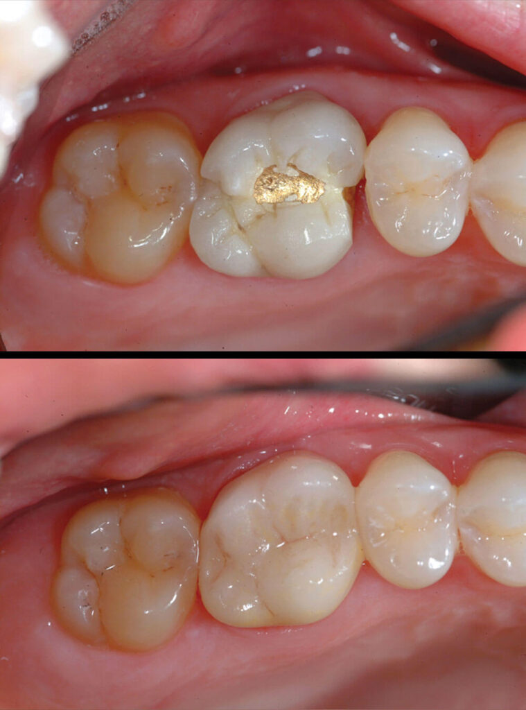 Before & after Crowns treatment