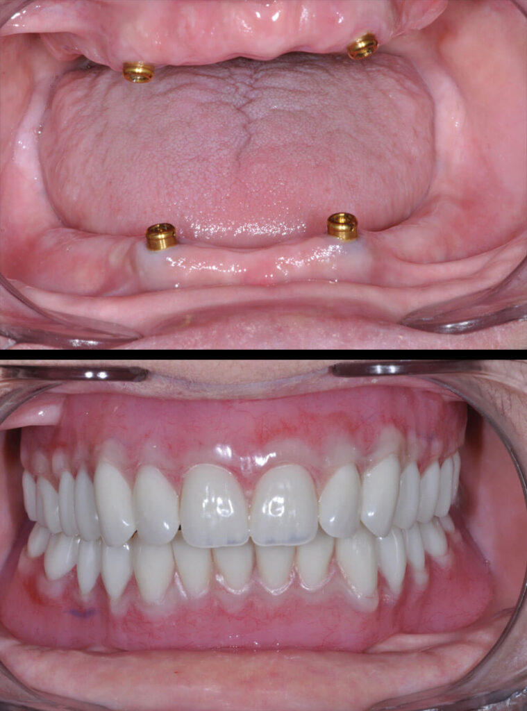 Before & after Dentures treatment