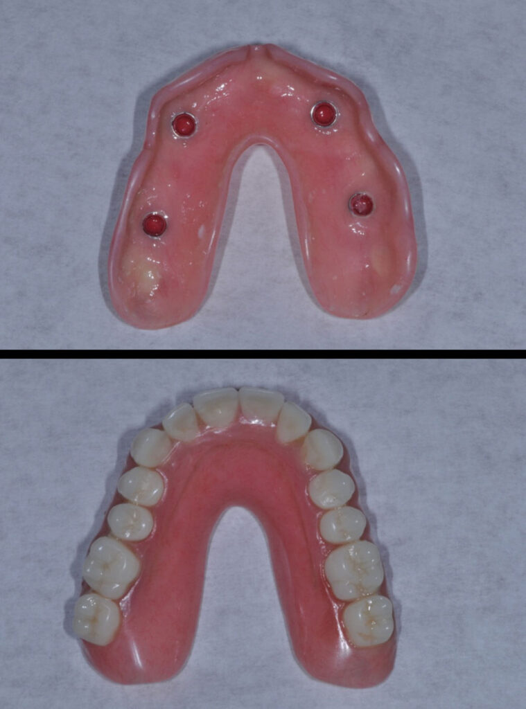 Before & after Dentures treatment