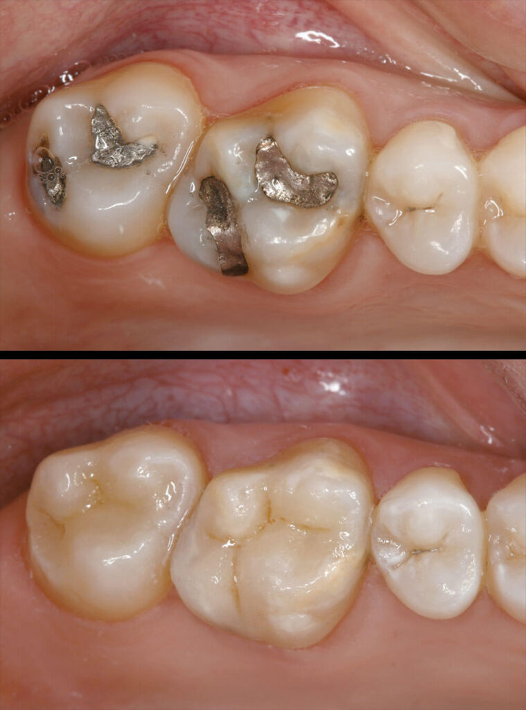 Before & after Inlay treatment