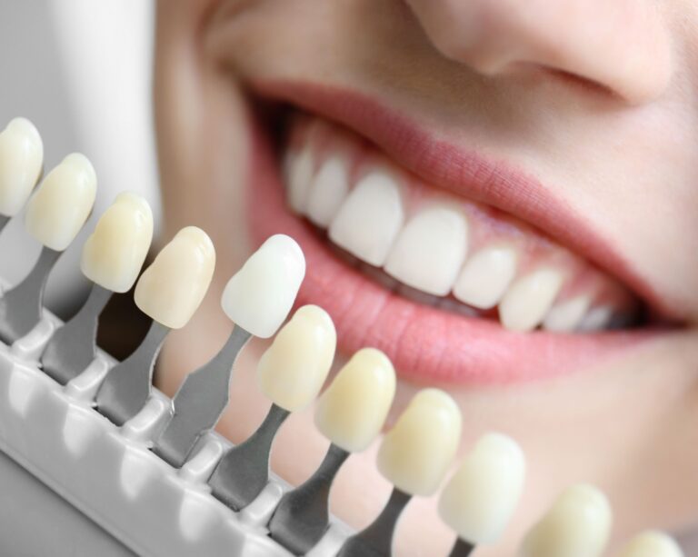 A close up of a smile with a tooth shade bar in front of it