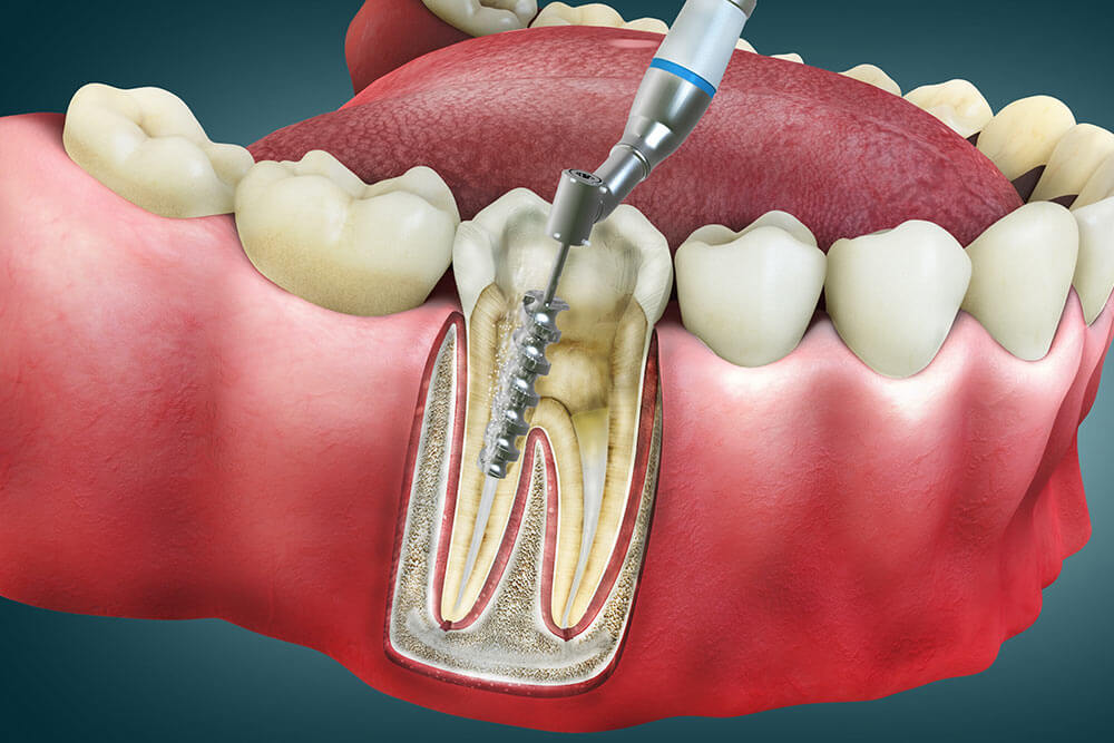 Root Canal Treatment - 3d illustration