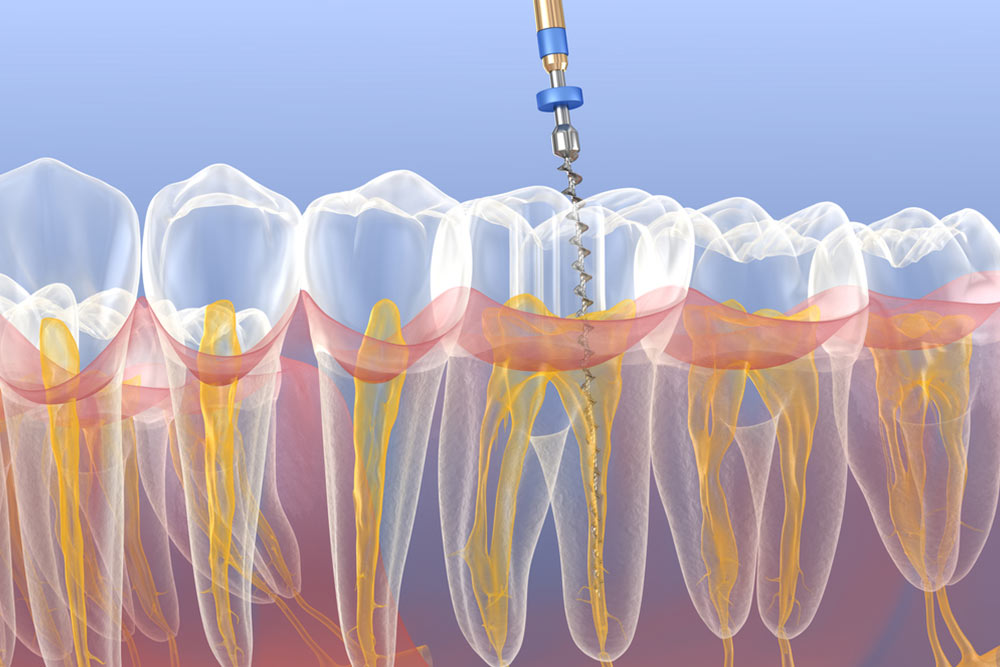 Endodontic root canal treatment process. Medically accurate tooth 3D illustration