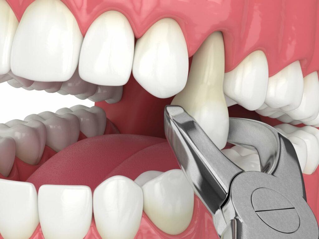 3d render of lower jaw with tooth extracted by dental forceps