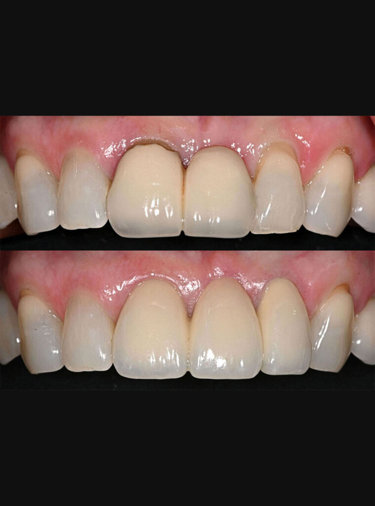 Before after Smile Makeover treatment