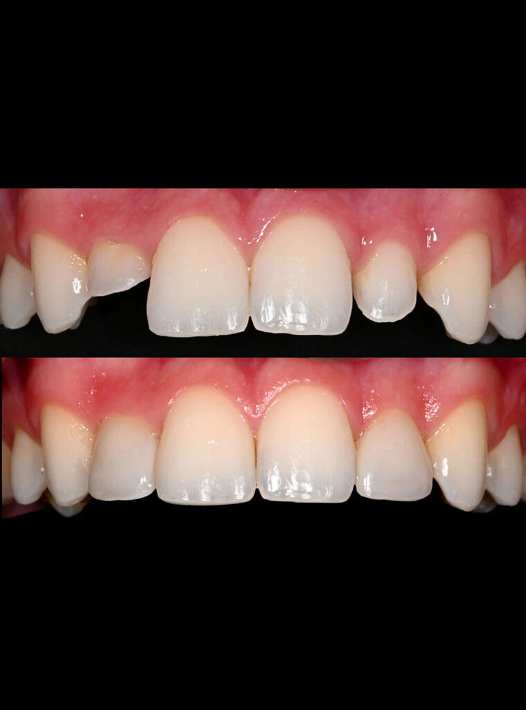 Before after Smile Makeover treatment