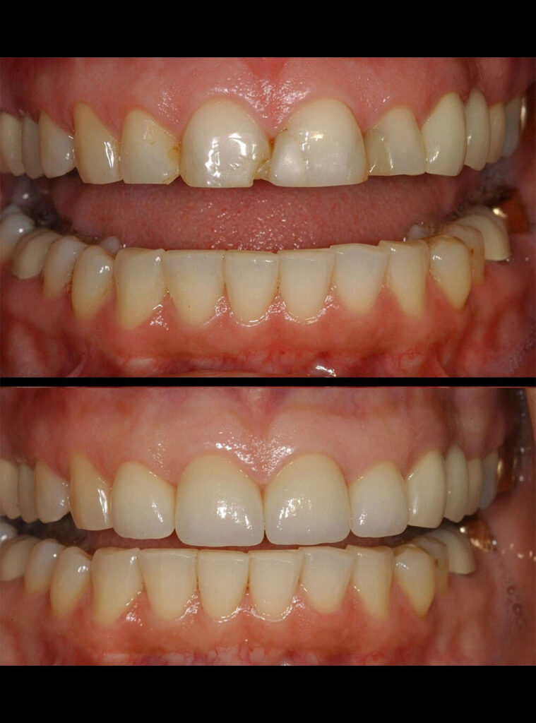 Before after Smile Makeover treatment