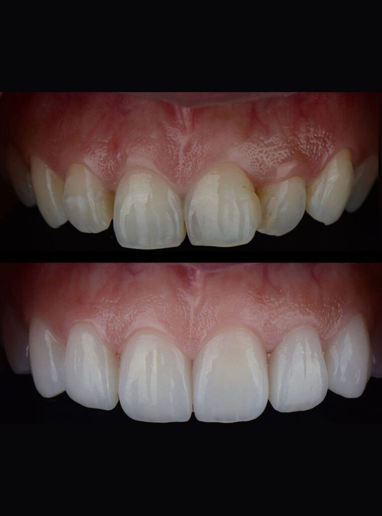 Before after Smile Makeover treatment