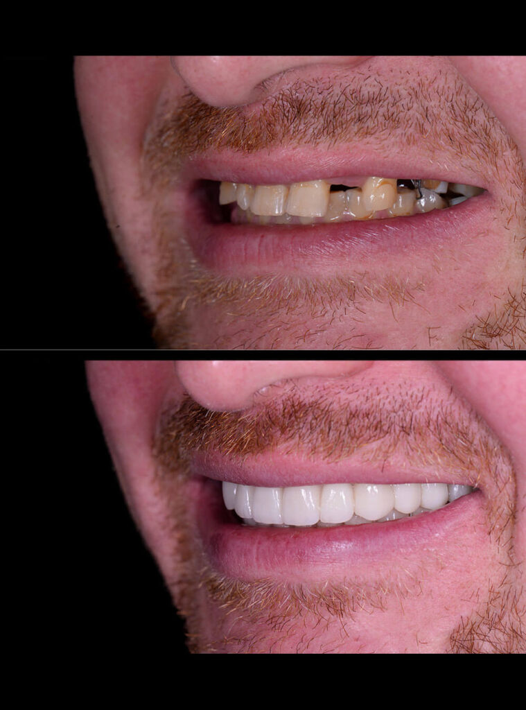 Before after Bonding, Veneers, and Bleaching treatment