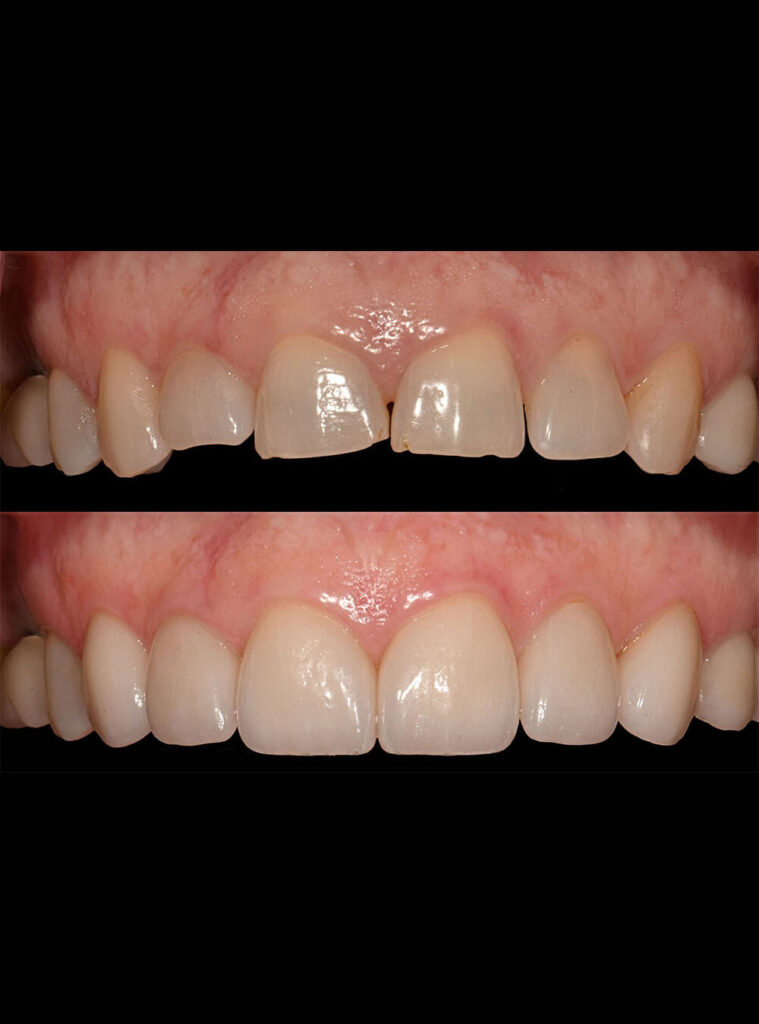 Before after Smile Makeover treatment