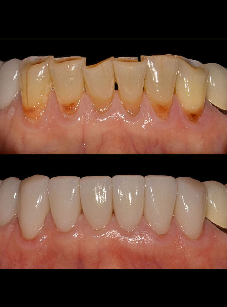 Before after Smile Makeover treatment