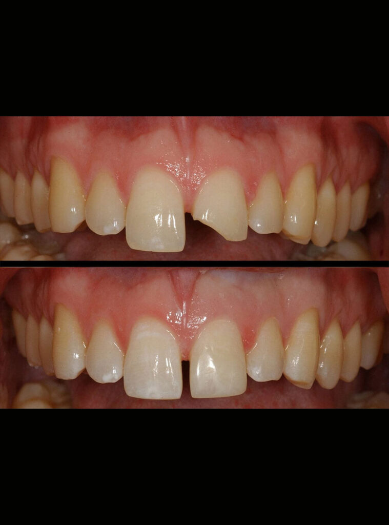 Before after Smile Makeover treatment